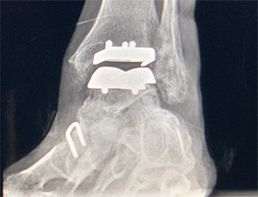 Ankle Replacement and Valgus Deformity