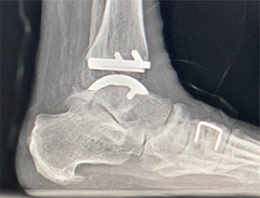 Ankle Replacement and Valgus Deformity