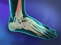 Ankle Ligament Reconstruction