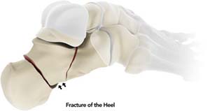 Heel Fractures
