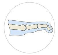 Mallet Toe