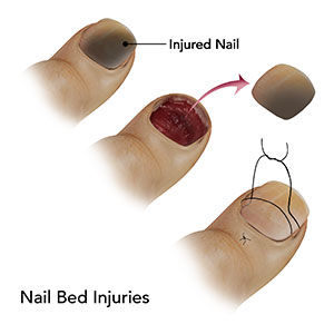 Nail Bed Injuries 