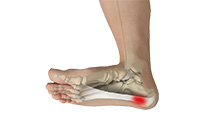 Plantar Fasciitis