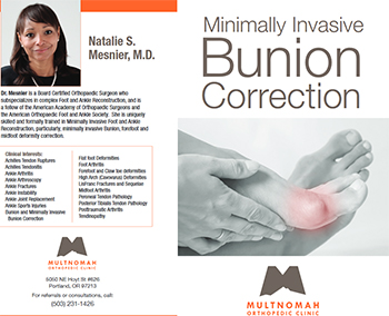 Bunion Minimally Invasive  Correction